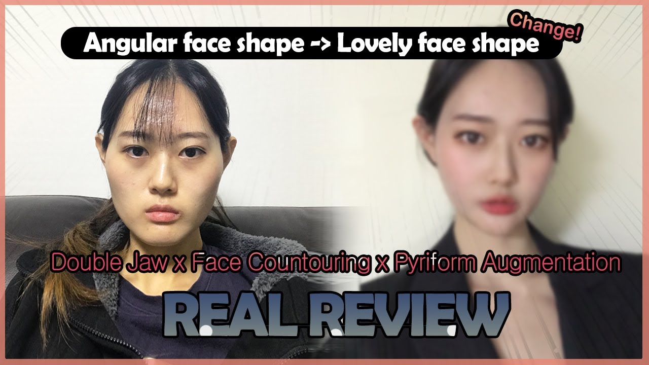 💜REAL REVIEW💜 A review of the ‘Double Jaw’ by a VIEW’s doctor. #koreaplasticsurgery