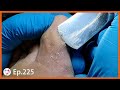 Ep.225 - Satisfying Slowly Shave Dead Skin Off Construction Worker&#39;s Foot