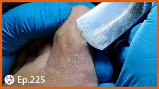 Ep.225 - Satisfying Slowly Shave Dead Skin Off Construction Worker&#39;s Foot