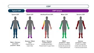 Optimizing Outcomes in CIDP: Honing Diagnostic Accuracy, Personalizing Treatment Plans