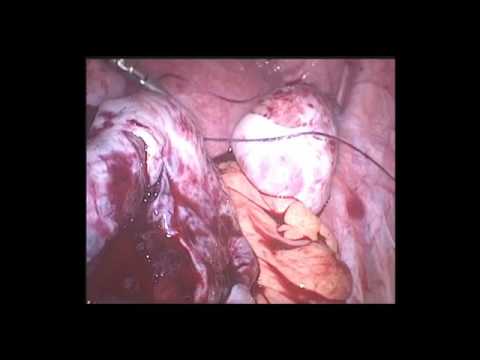Laparoscopic Torsion Ovary by Dr. Nikita Trehan