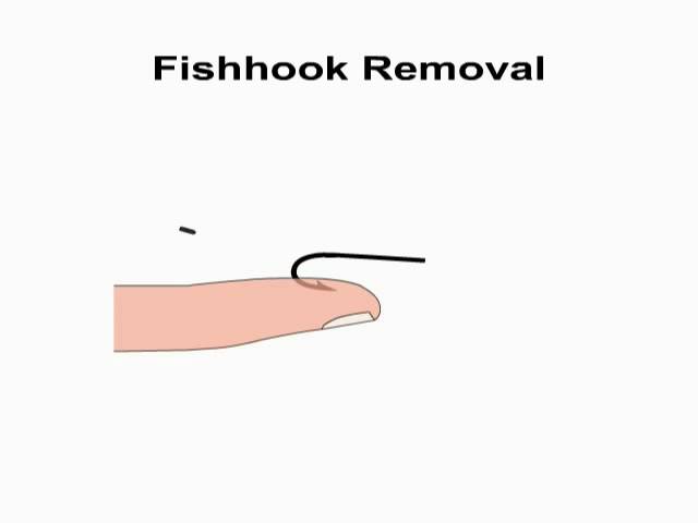 Animated Fish Hook Removal - String yank technique by NetKnots