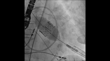 TAVR-Transcatheter Aortic Valve Replacement: Transapical Deployment