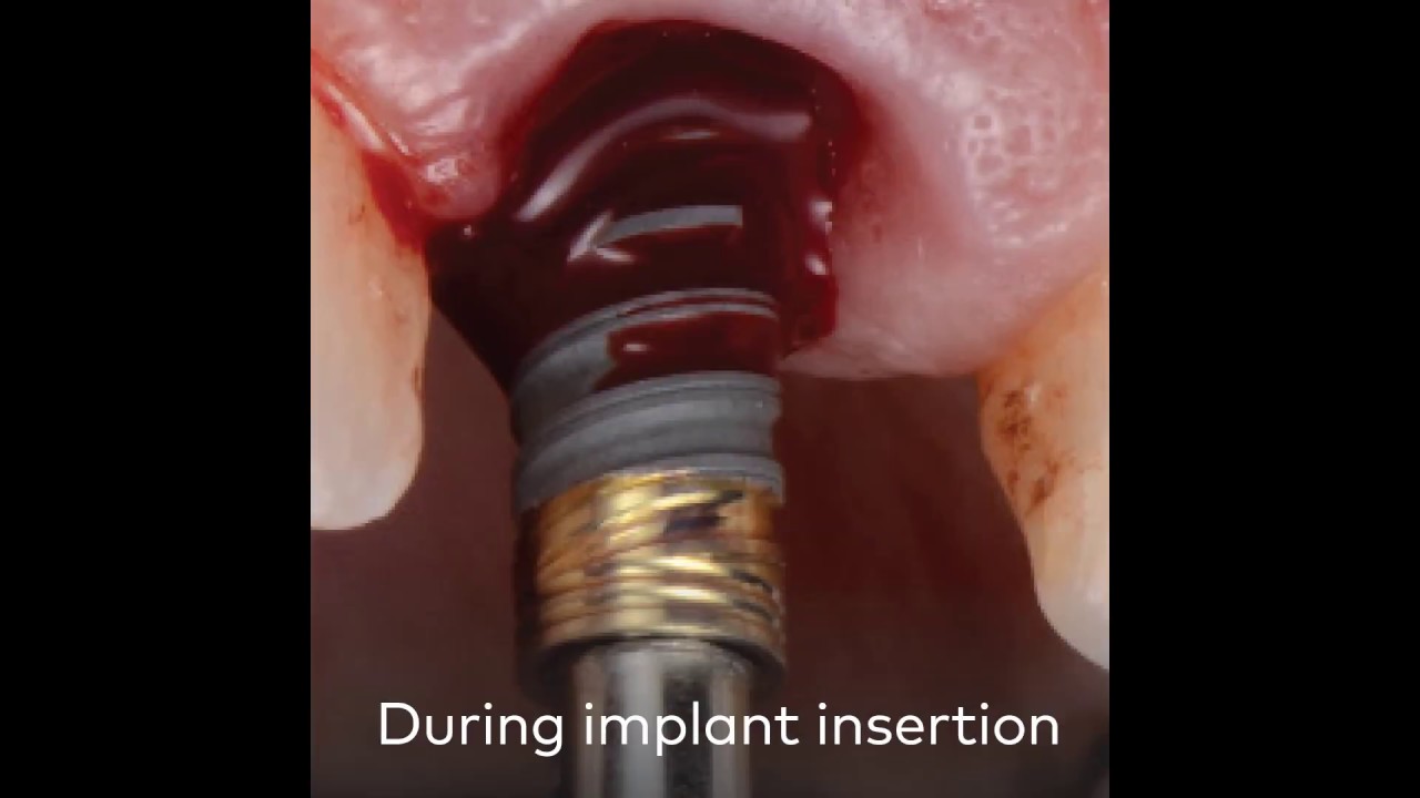 Clinical case Failing endodontic treatment of a central incisor YouTube