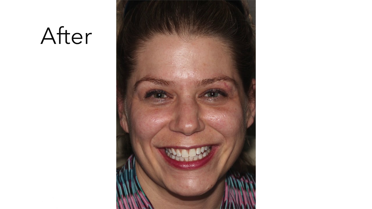 Teeth Whitening Printers Row Dental Studio YouTube