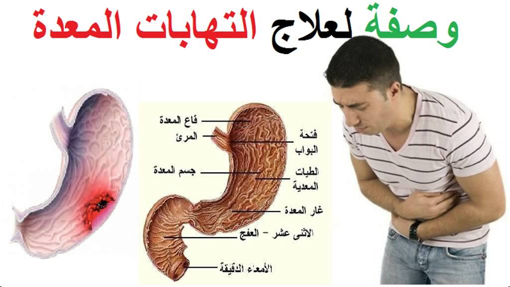 بالنسبة لتأثر أنسجة المعدة فإن التهاب المعدة يقسم إلى التهاب تآكلي (سحجي) e...