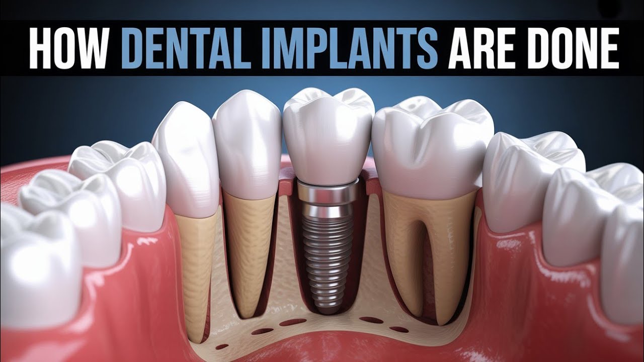How Dental Implants Are Done | Complete Surgical Guide