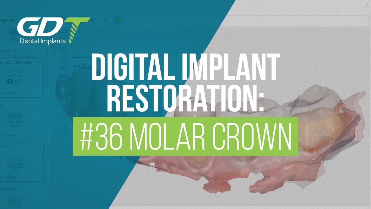 Digital Precision: Crown for #36 Molar with GDT Implants CAD/CAM and Advanced Tech