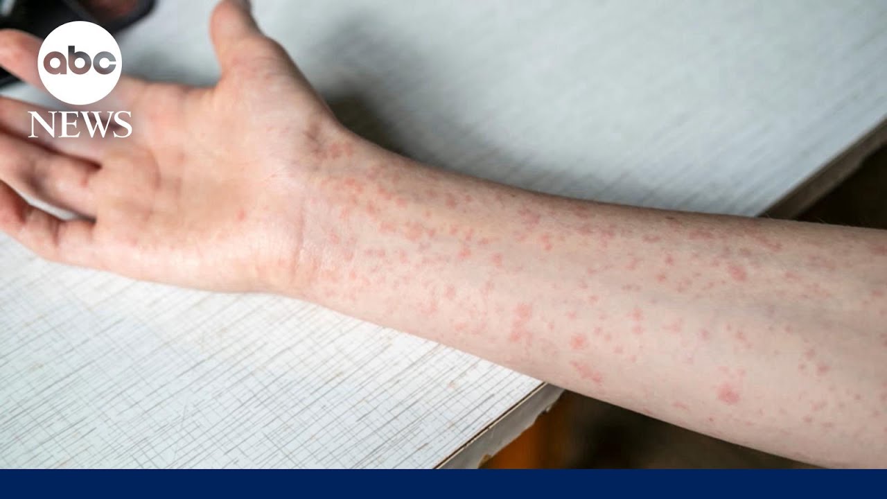 South Carolina measles outbreak doubles within a week