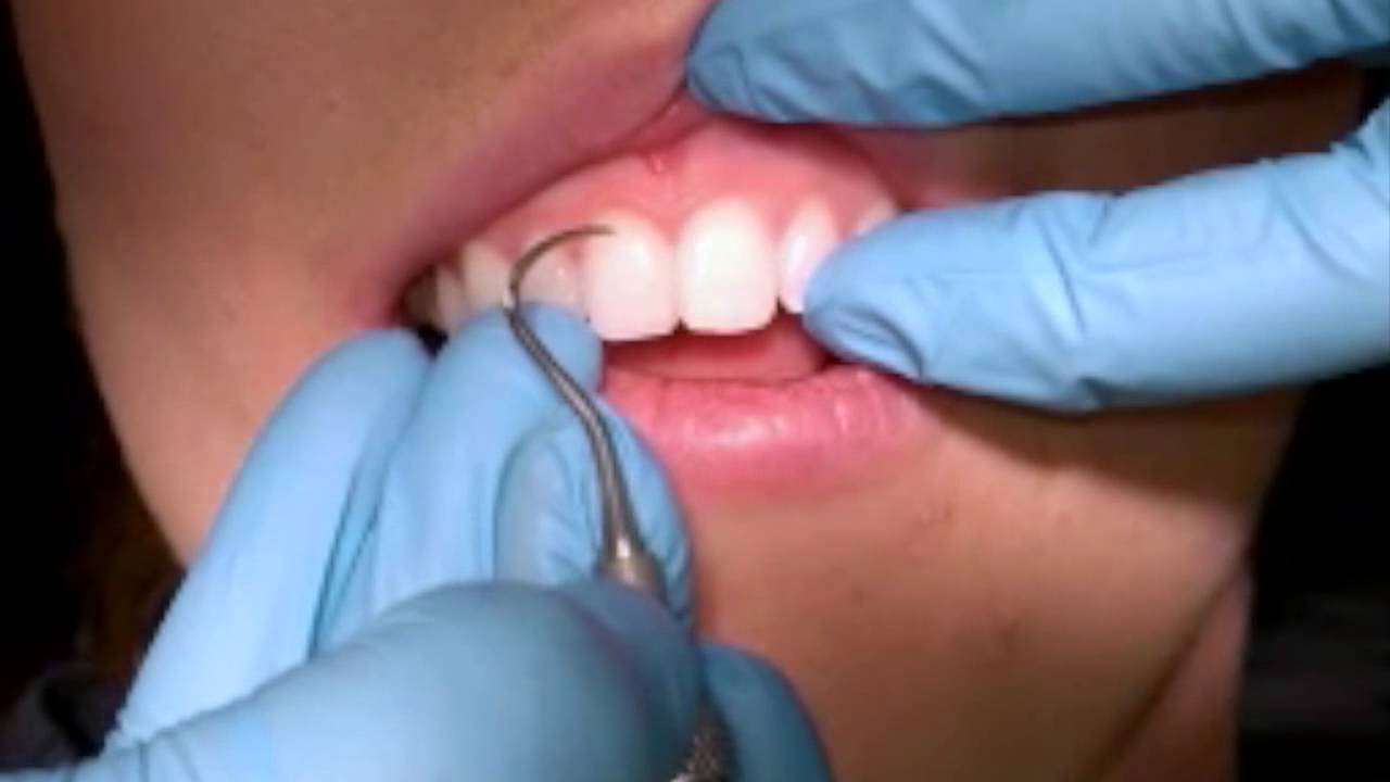 Anterior H6 7 Sickle Scaler Youtube Anterior H6 7 Sickle Scaler Youtube