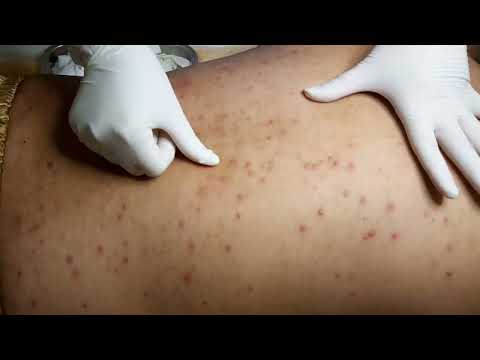 Video Mụn lưng do dùng thuốc thải độc, đẩy mụn | Back acne |... - youtube