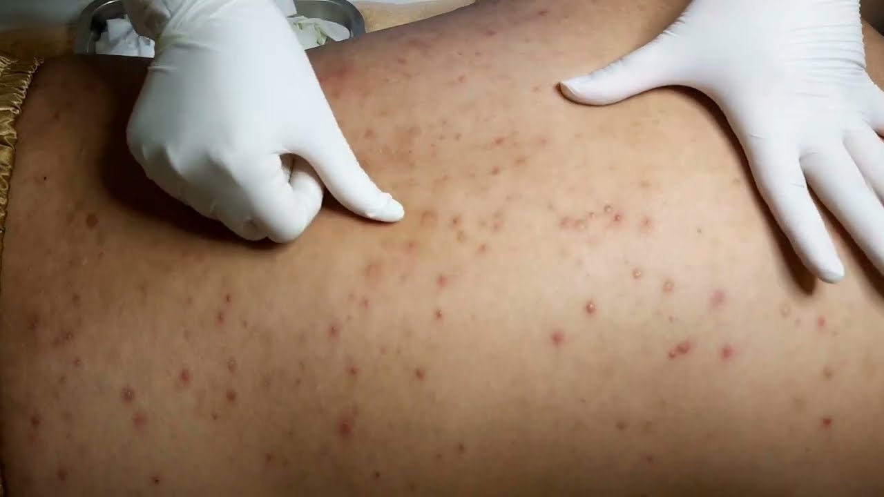 Mụn lưng do dùng thuốc thải độc, đẩy mụn | Back acne | HHV Clinic | Đỗ Thu Hiền | Hiền Vân Spa
