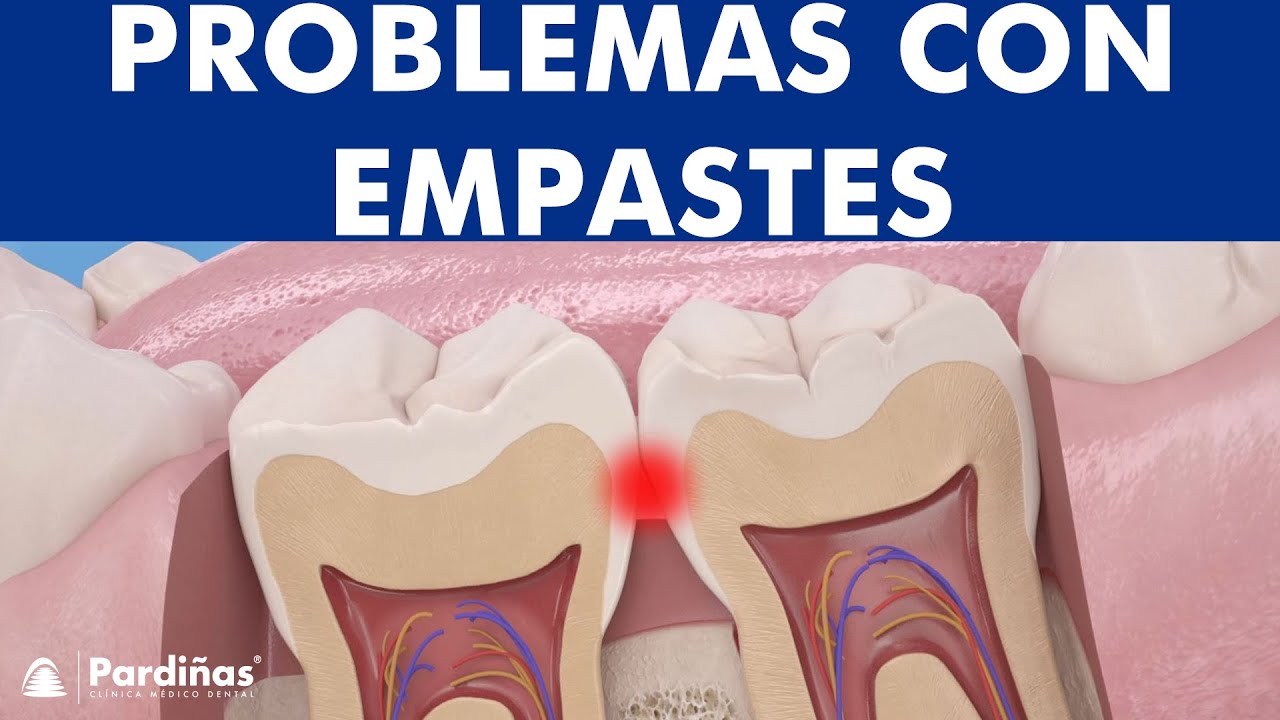 ¿Cómo se realiza un empaste dental? Paso a paso del empaste dental