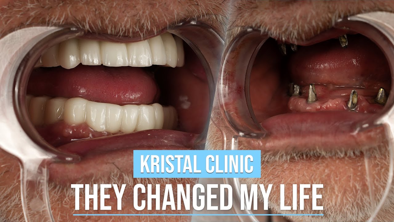 Dental Implants in Turkey: A Perfect Smile Made Affordable!