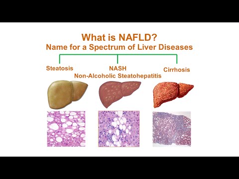 Video: Este nafld considerată boală hepatică?