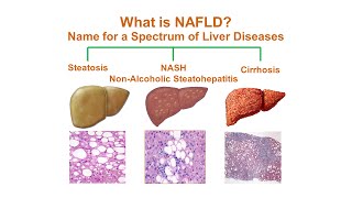 What is NonAlcoholic Fatty Liver Disease (NAFLD)?