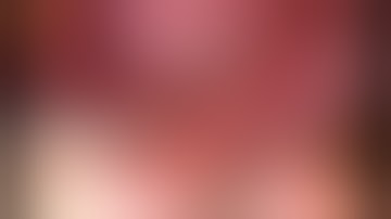 Subxiphoid Uniportal VATS middle lobectomy