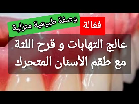 كيفية علاج التهابات و قرح اللثة مع طقم الأسنان المتحرك بطريقة طبيعية منزلية بسيطة
