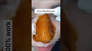 How to remove blackheads/Whitehead naturally ?| | shorts viral blackhead