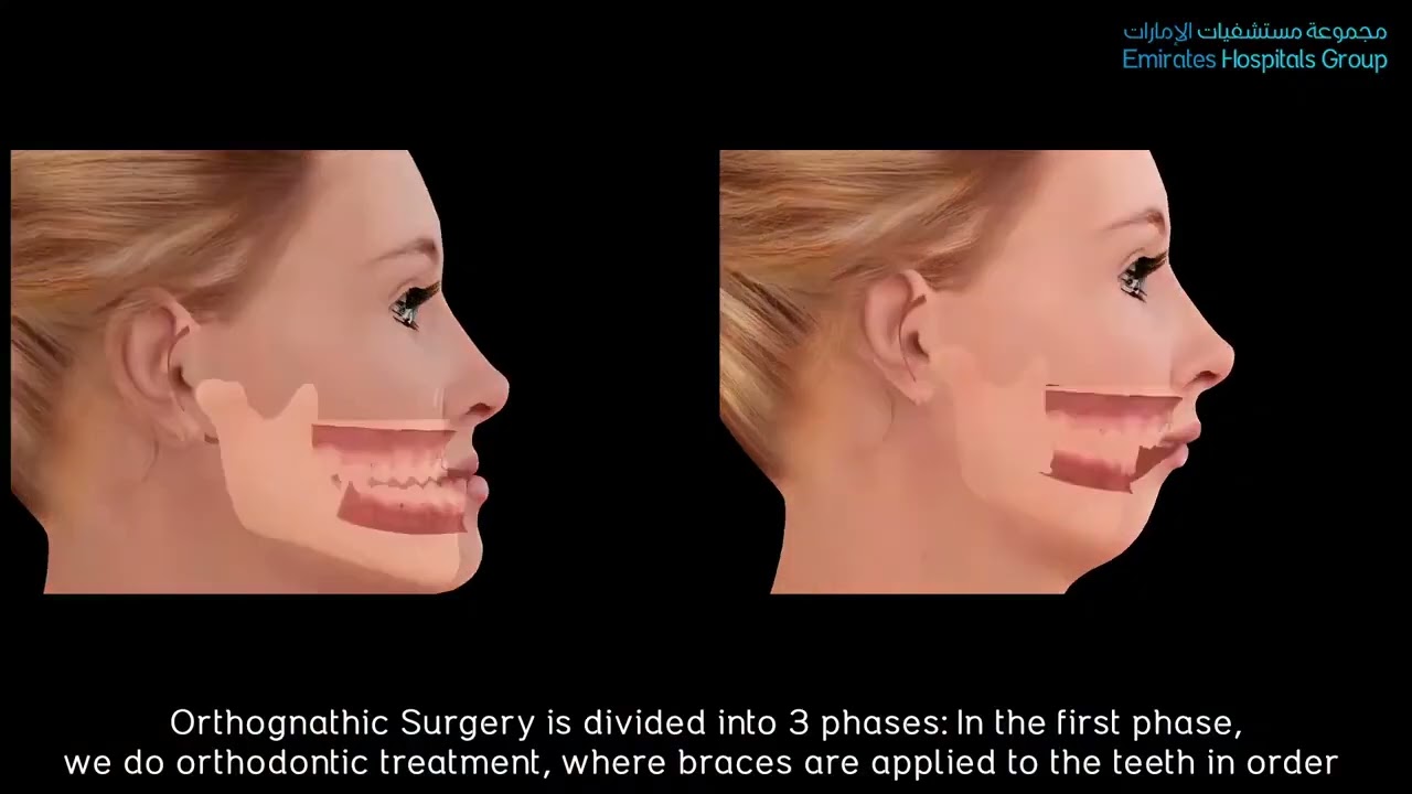 جراحة تقويم الفكين   البروفيسور د  جهاد السخن   Orthognathic Surgery