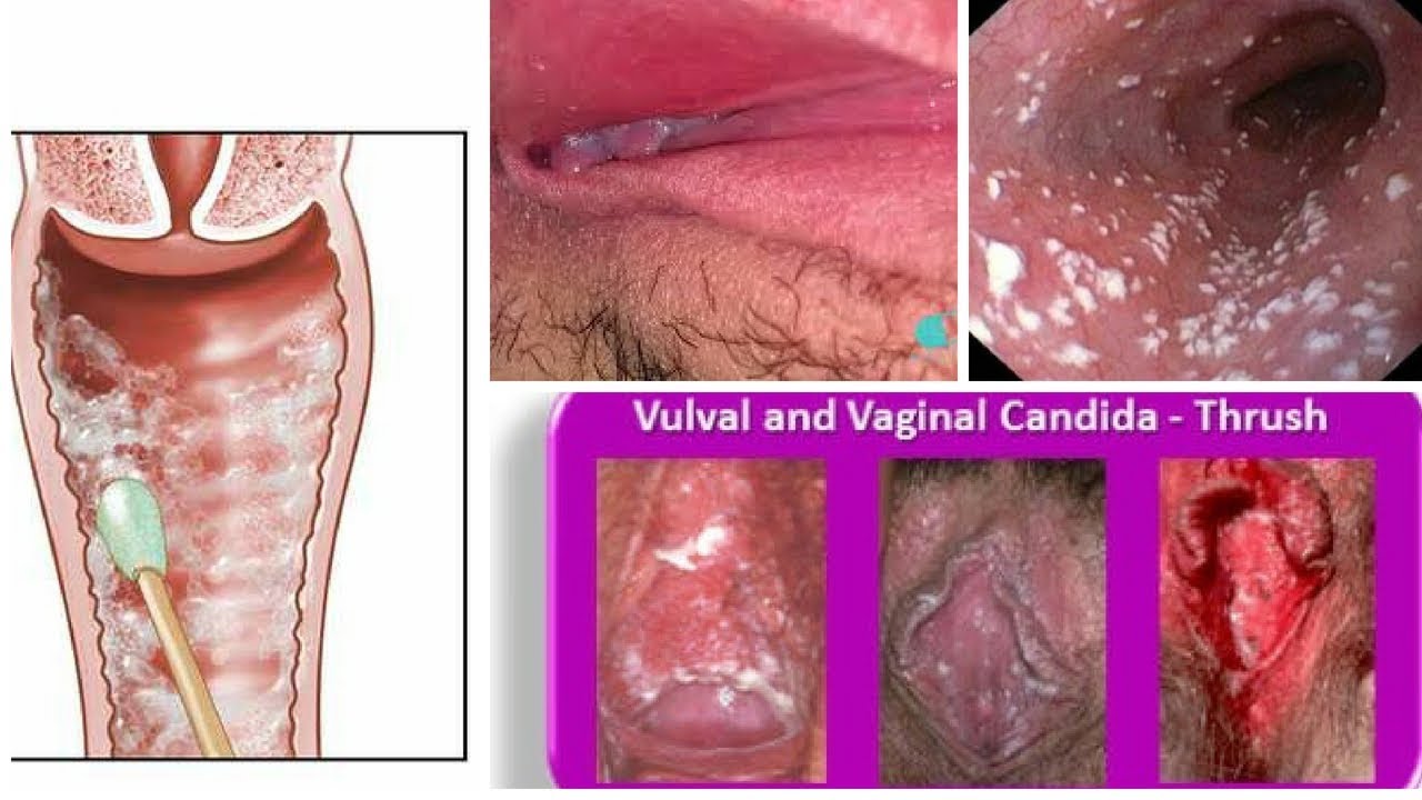 Candidiasis intestinal como se detecta