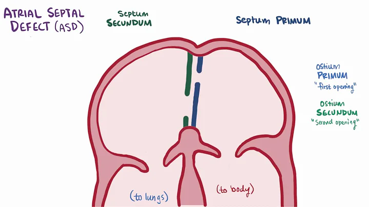 Atrial septal defect ASD repair, causes, types, symptoms & pathology - DayDayNews