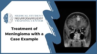 Treatment of Meningioma with a Case Example