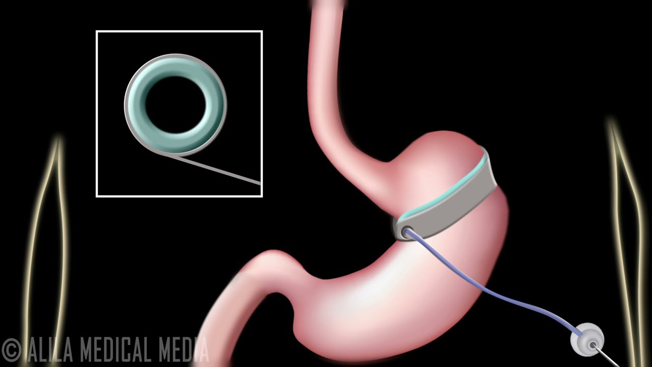 How the LAP-BAND System Offers Bariatric Surgery Patients Fewer Risks and  Side Effects - Birmingham Minimally Invasive Surgery