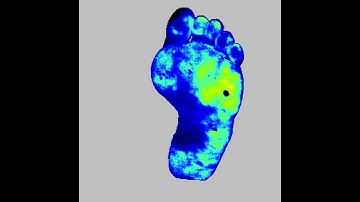 PeriCam PSI for Diabetic Foot Ulcers