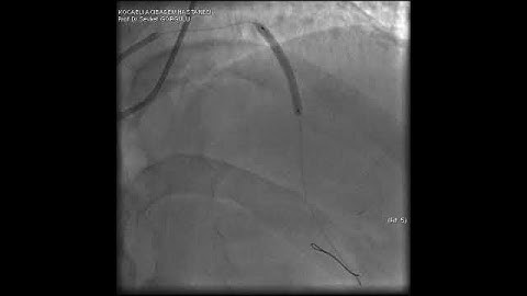 Microcatheter Tip Fracture During LAD CTO PCI: A Complication Video 9