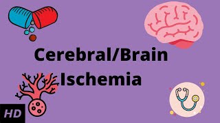 Cerebral/Brain Ischemia, Causes, Signs and Symptoms, Diagnosis and Treatment.