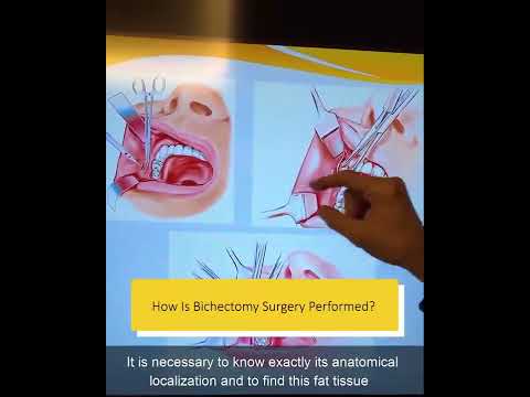 Bişektomi Ameliyatı Nasıl Yapılır? | Bişektomi (Yanak Estetiği) Ameliyatı | Doç. Dr. Erdem Güven