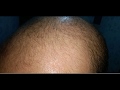 مراحل انبات الشعر ب استخدام بخاخ المينوكسديل Minoxidil تجربتي 