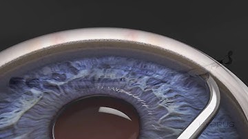 Hydrus Microstent Implantation Animation