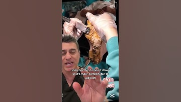 Doctor Reacts To Foot With Excess Skin!