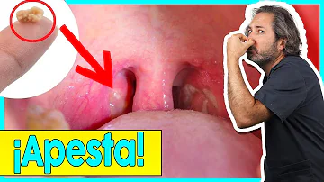 ¿Cómo se elimina el pus de la amigdalitis?