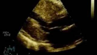 Echo-Web - Hypertrophic Obstructive Cardiomyopathy