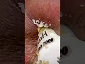 blackhead removal from nose/ old aged blackheads removal
