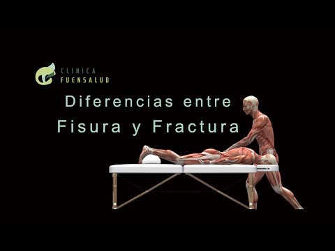 Vídeo: Diferencia Entre Escote Y Fractura