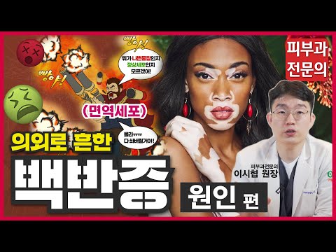 (sub)백반증은 왜 생기는 걸까? 100명중 1명은 있다는 꽤 흔한 백반증의 원인과 진단방법! - 백반증 1편