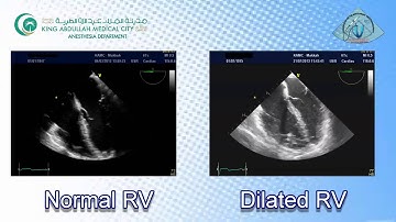 046 RV function & Pulmonary Embolism TEE KAMC