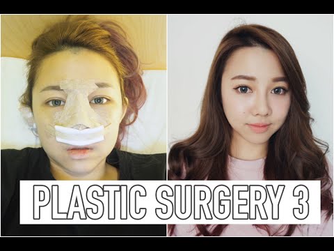 MY PLASTIC SURGERY EXPERIENCE IN KOREA | PT.3 [END] - YouTube