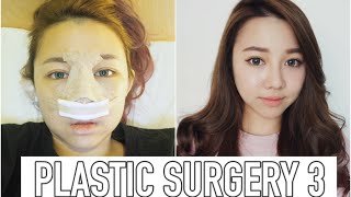 MY PLASTIC SURGERY EXPERIENCE IN KOREA | PT.3 [END]