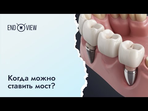 Мостовидный протез —