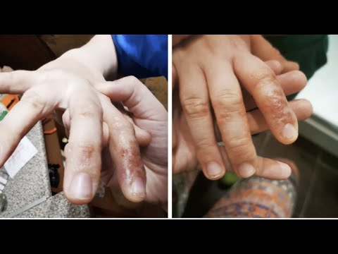 ჯვარზე გაკრული ქრისტეს მსგავსად... ამ ბიჭს ხელებიდან მუდამ სისხლი სდის!