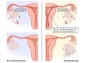 Endometriosis- Part I