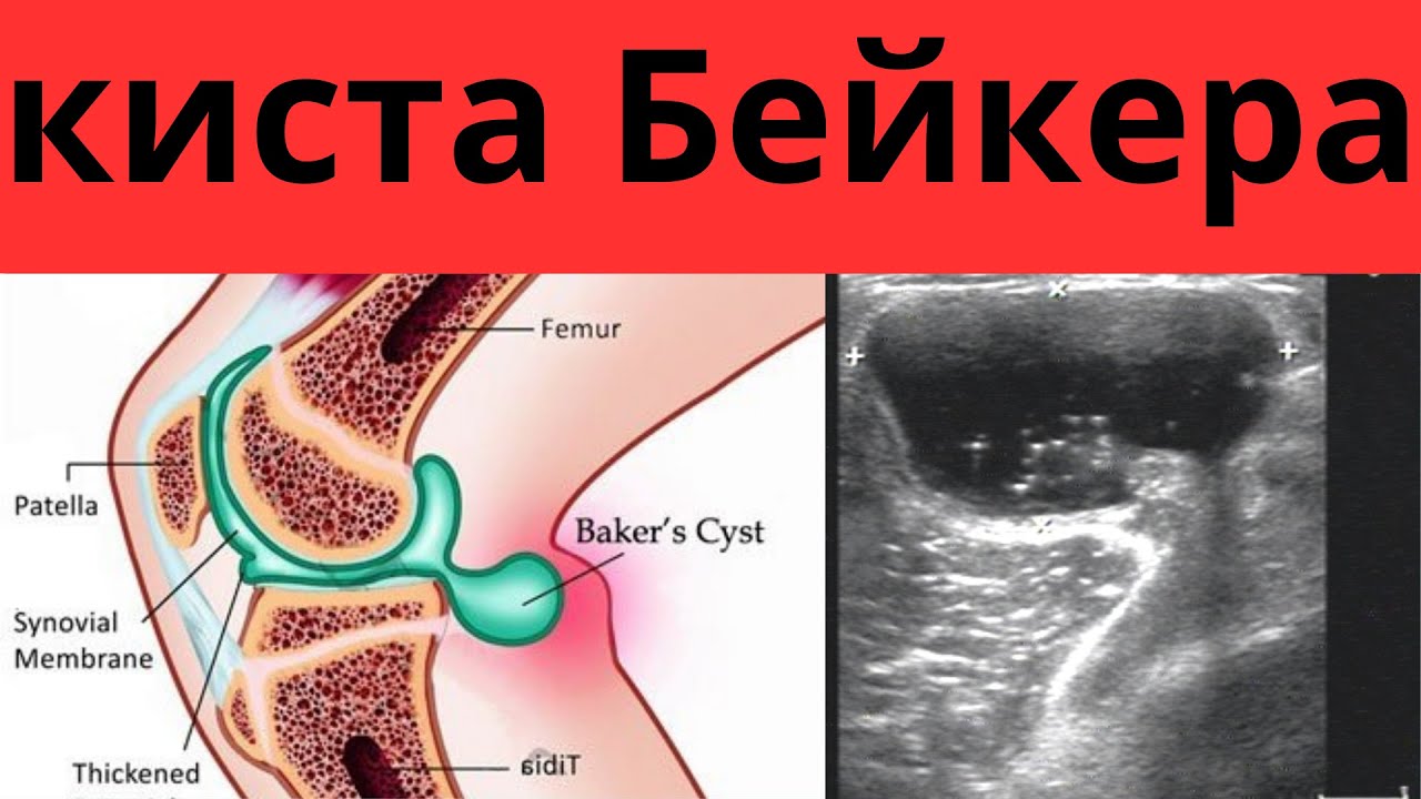 Киста Бейкера. Грыжа подколенной ямки - YouTube