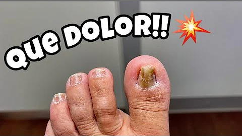 ¿Cómo adormecer el dedo del pie para eliminar una uña encarnada en casa?