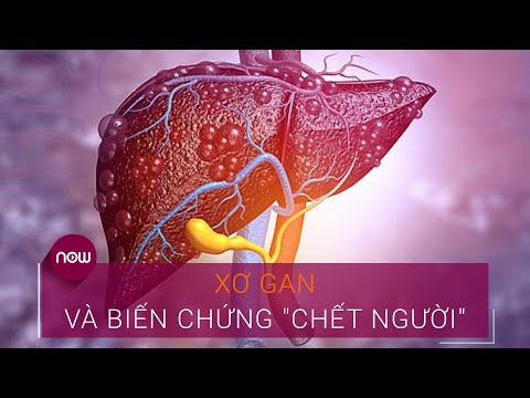 Video: Mệt mỏi đau cơ xơ hóa: Nó khác với mệt mỏi như thế nào và phải làm gì