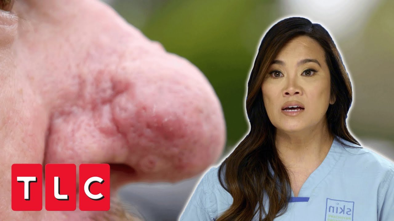 Dr Reconstructs A Nose With Rhinophyma | Dr Pimple Popper Pop Up | CENSORED